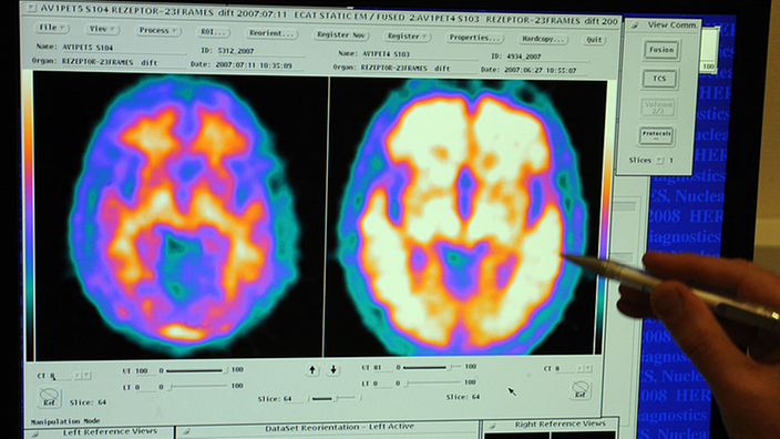 Die Hirnaufnahme aus einer Positronen-Emissions-Tomographie.