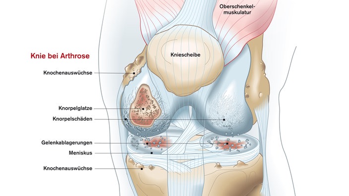 Zeichnung eines Knies mit Arthrose