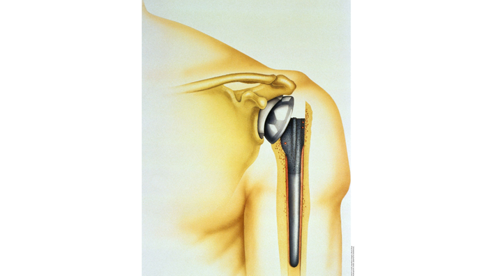 Graphische Darstellung eines künstlichen Schultergelenks