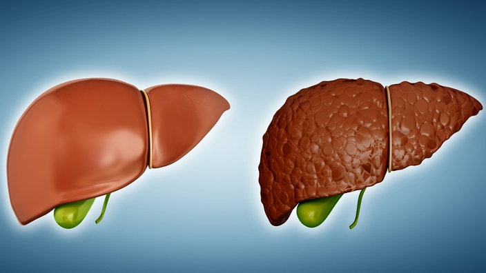 Vergleich einer gesunden Leber (links) und einer Leberzirrhose (rechts)
