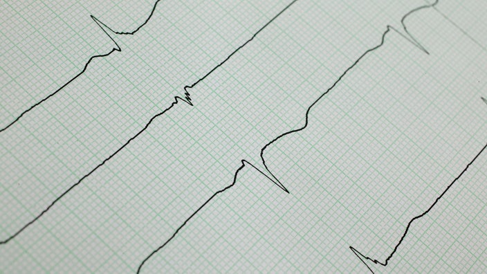 Der Audruck eines EKG-Gerätes