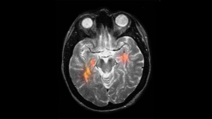 Hirnscan aus dem MRT